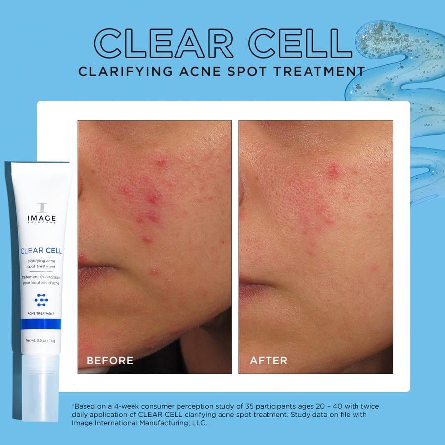 Before and after example for IMAGE Skincare CLEAR CELL clarifying acne spot treatment