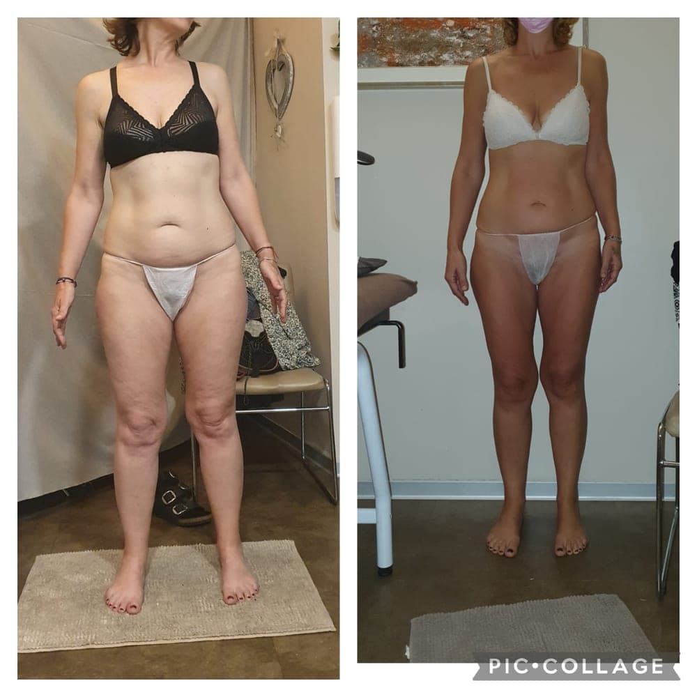 Before and after example for Endospheres body treatment