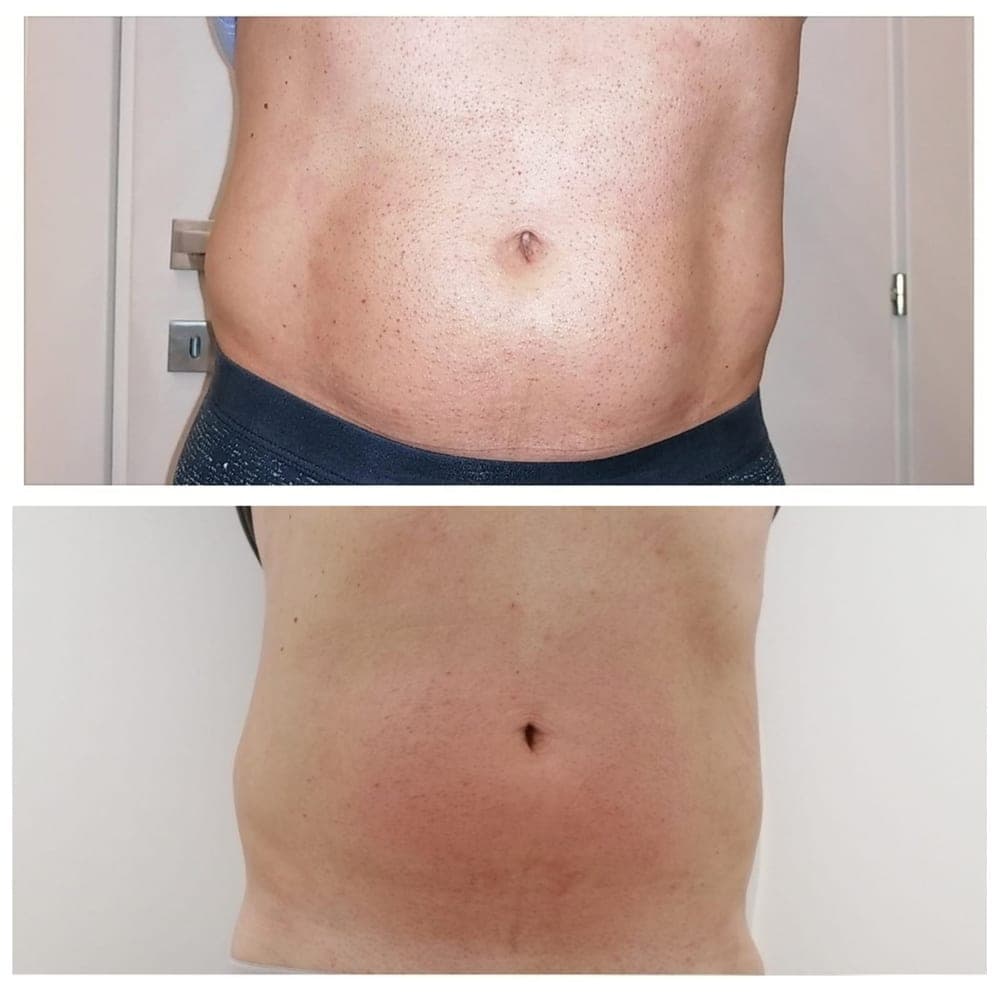 Before and after example for Endospheres body contour treatment