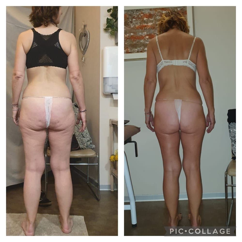 Before and after example for Endospheres tissue tone