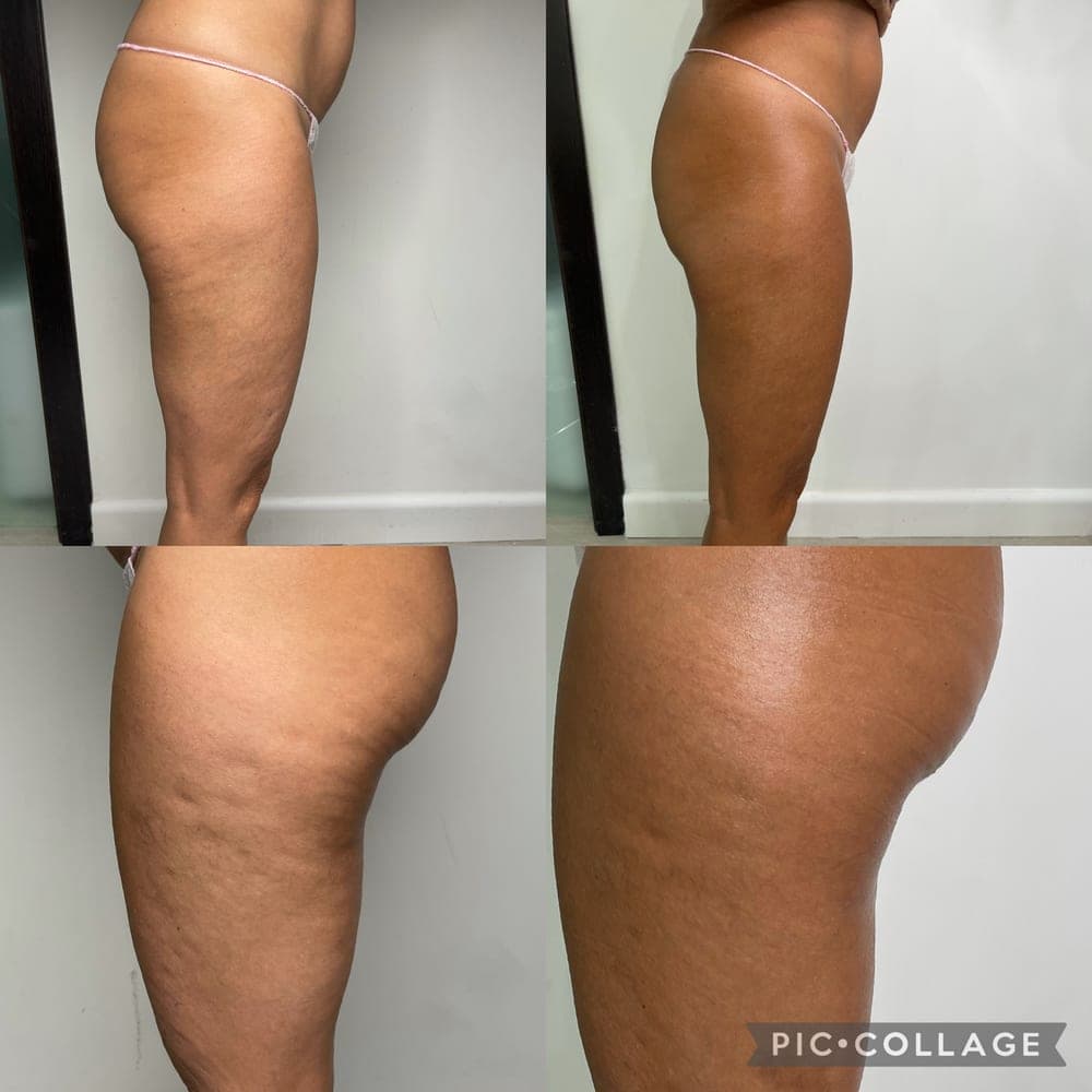 Before and after example for Endospheres body recovery
