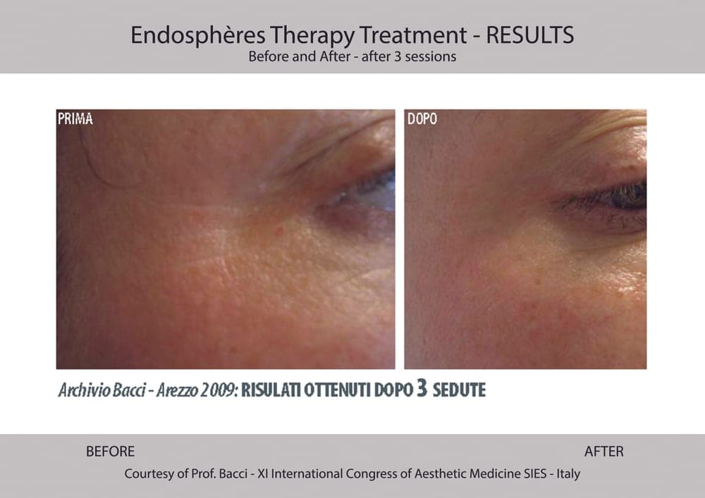 Before and after example for Endospheres face treatment