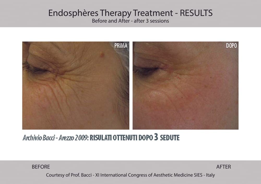 Before and after example for Endospheres facial tissue tone