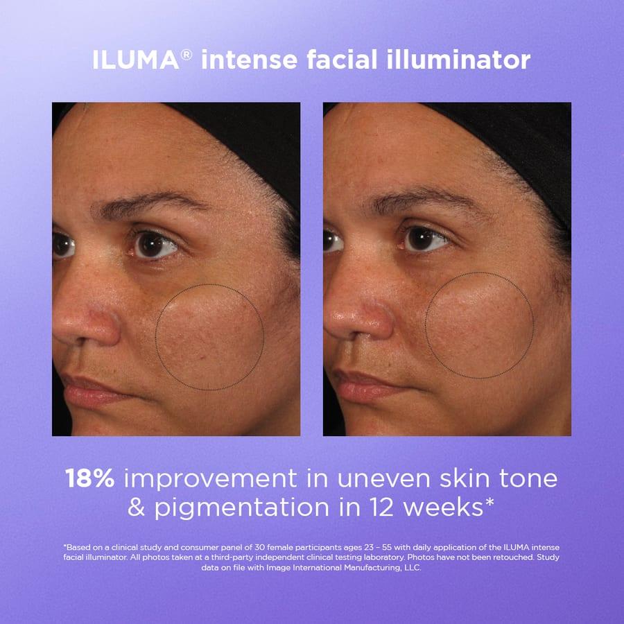 Before and after example for IMAGE Skincare ILUMA brightening care
