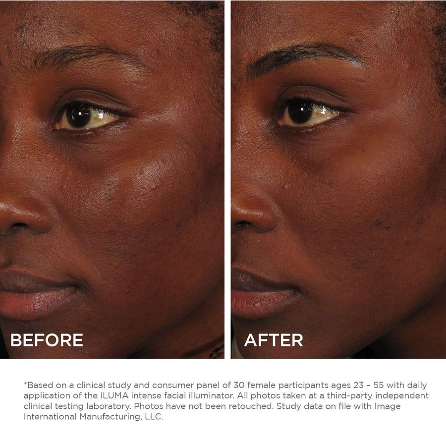 Clinical example for IMAGE Skincare ILUMA intense facial illuminator