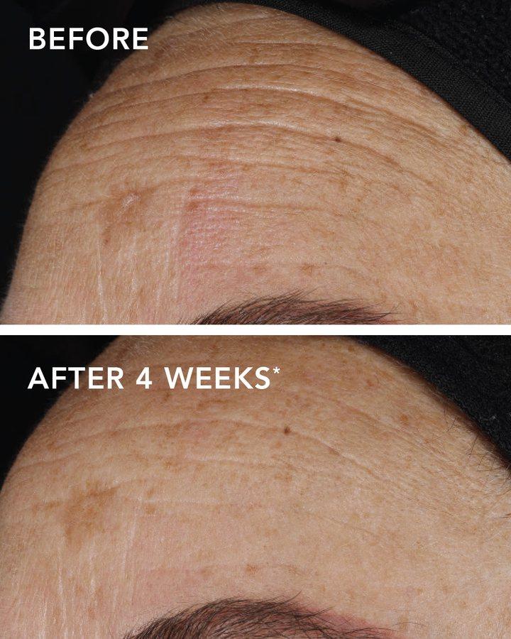 Before and after example for AGELESS+ pure liquid retinol 0.1%