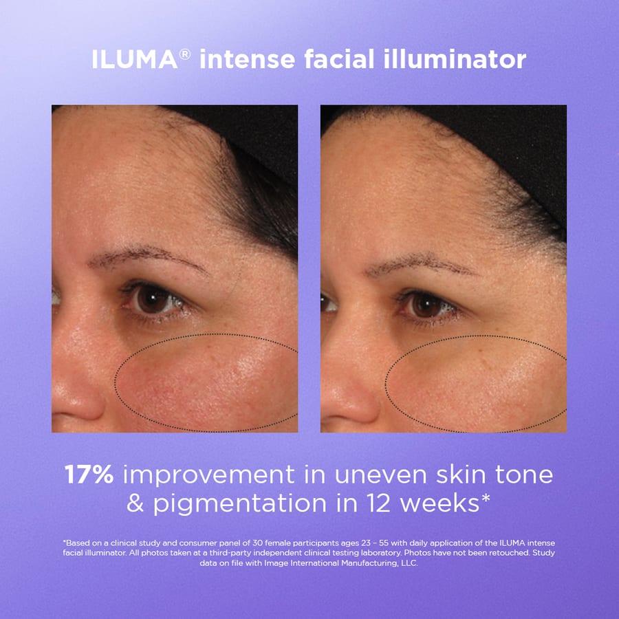 Before and after example for IMAGE Skincare ILUMA