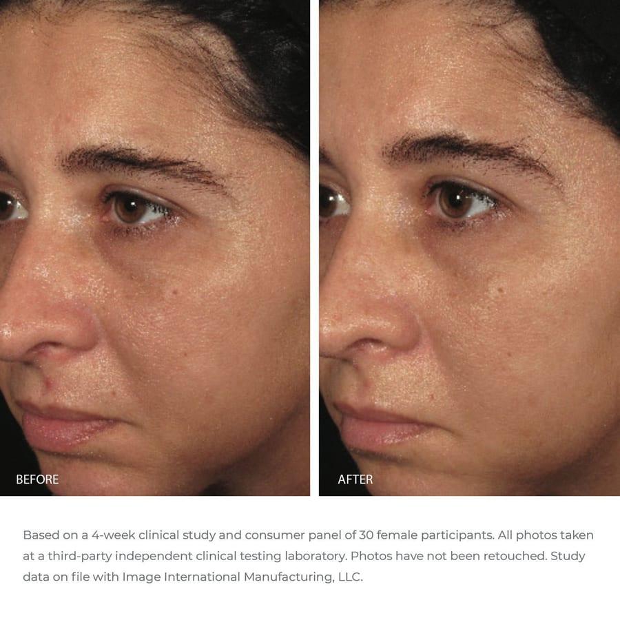 Clinical example for IMAGE Skincare ORMEDIC balancing bio-peptide creme